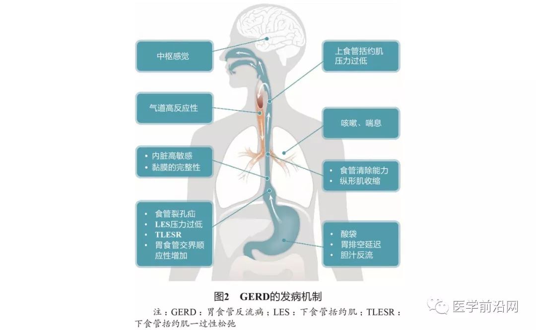 胃食管反流引起的哮喘咳嗽严重吗,胃食管反流性咽喉炎及反流性哮喘