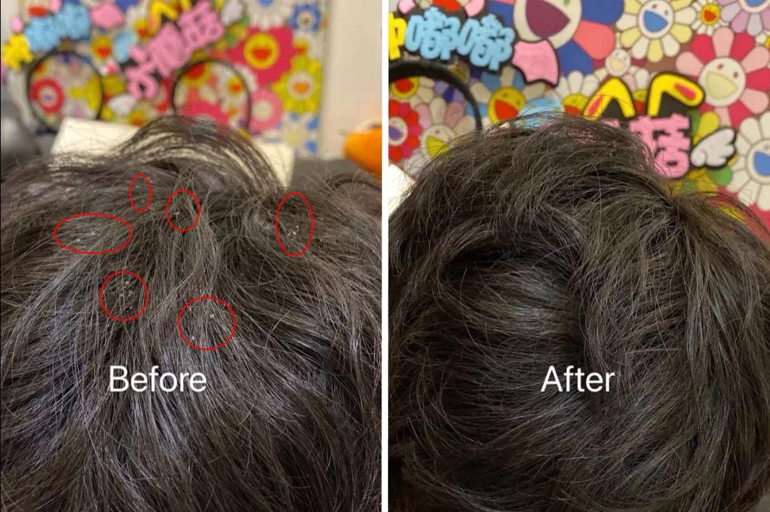 去头屑去螨虫哪个洗发水最有效,去头屑去螨虫用哪个洗发水最有效