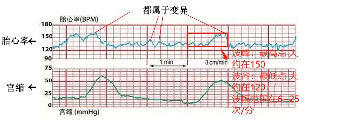 怎么能顺利快速通过胎心监护,怎么使胎心监护快速过关
