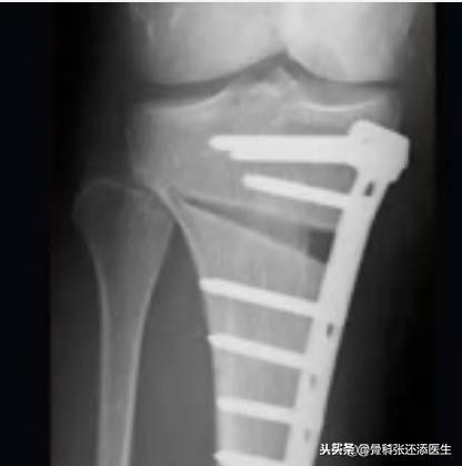 膝骨关节炎减轻疼痛的方法,膝盖骨关节炎怎么治疗效果最好