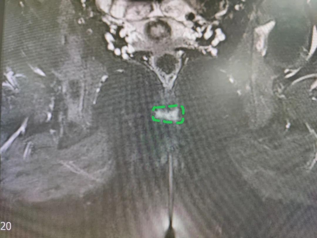 3省十几家医院,一个3mm病灶,让她硬生生忍了3年剧痛