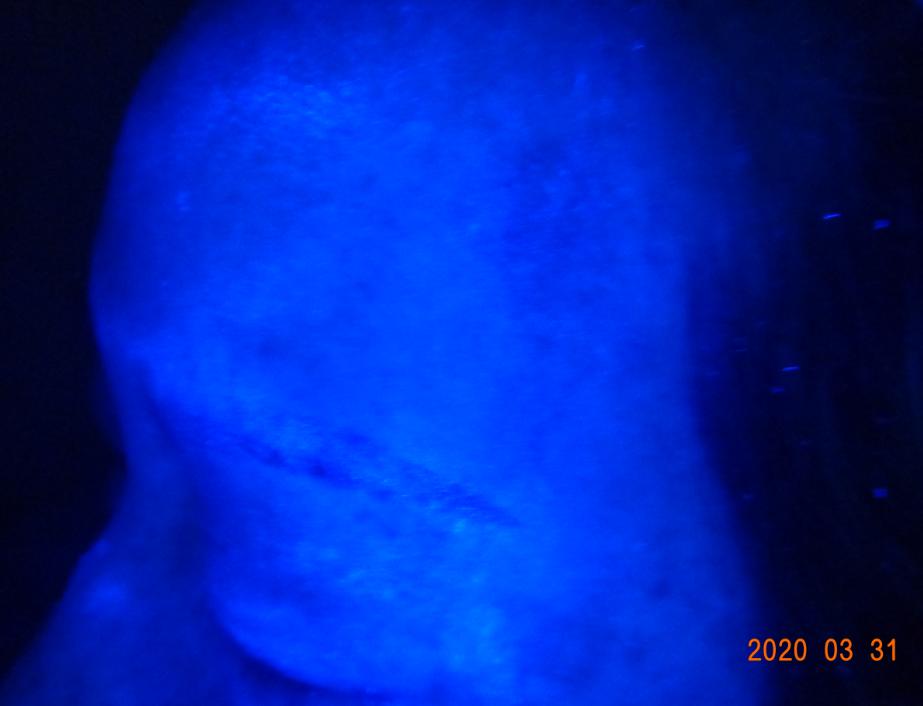 一位散发型白癜风患者的自白：坚持治疗能痊愈，千万别放弃自己