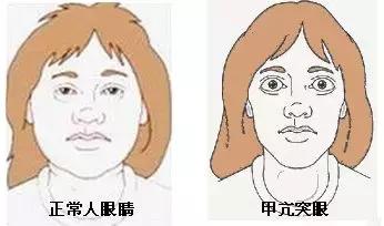 甲亢自我诊疗与全面调养的区别,甲亢防止复发