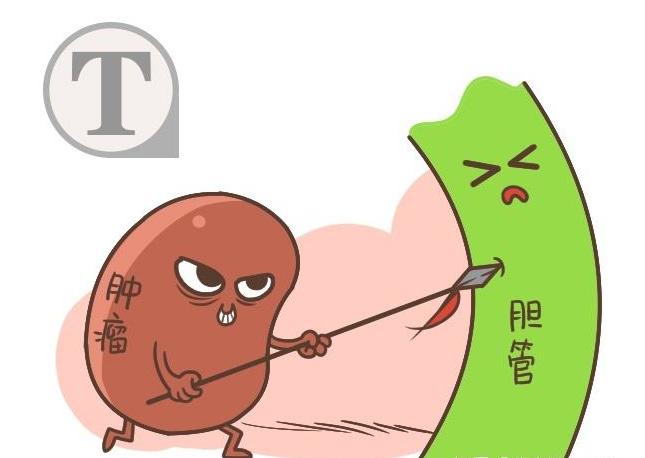 免疫治疗肝内胆管癌,胆道癌可以免疫治疗吗