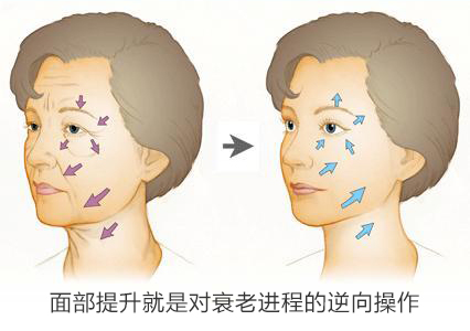 注射除皱玻尿酸和除皱针要怎么选,注射除皱和填充