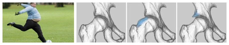 胯骨疼是不是骨折,胯骨疼是什么原因股骨头坏死