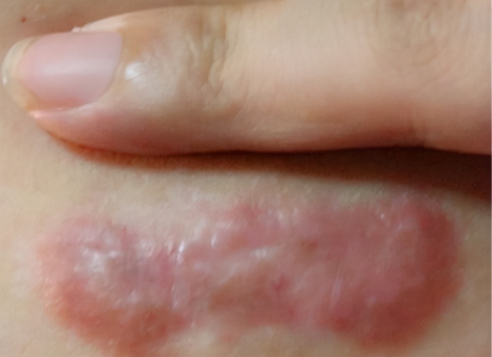 凸起的增生疤手术切除,增生性凸疤可以激光去掉吗