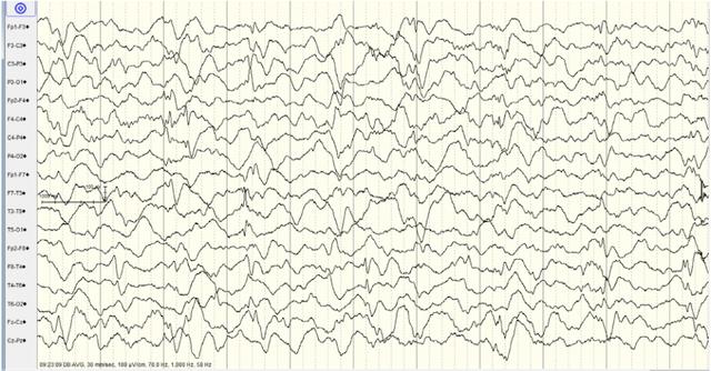 生酮初期症状及治疗方法,生酮饮食的疾病断根方法