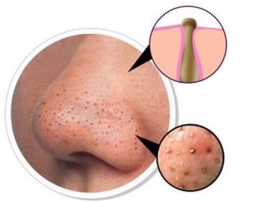 脸上的螨虫和被子里的螨虫,用了螨虫皂为啥脸上螨虫越来越多