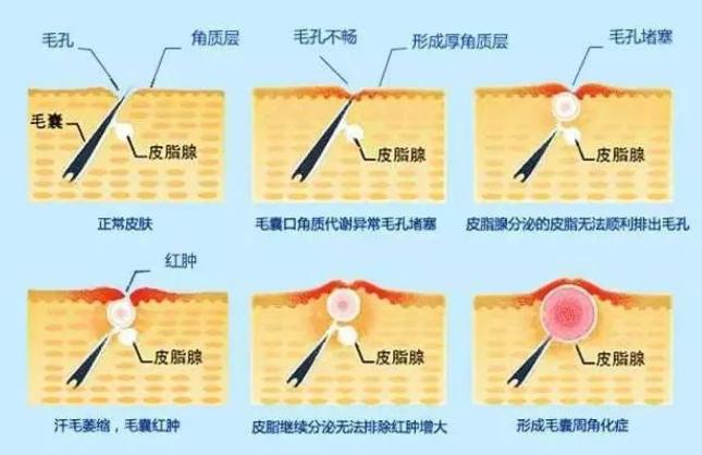 女生最怕“1孔1黑”,特别影响颜值,很多人女生中招还不自知