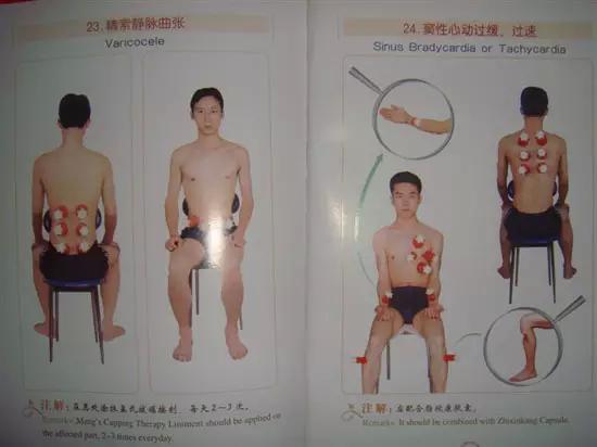 拔罐有哪些穴位图解,最全拔罐穴位疗法图解