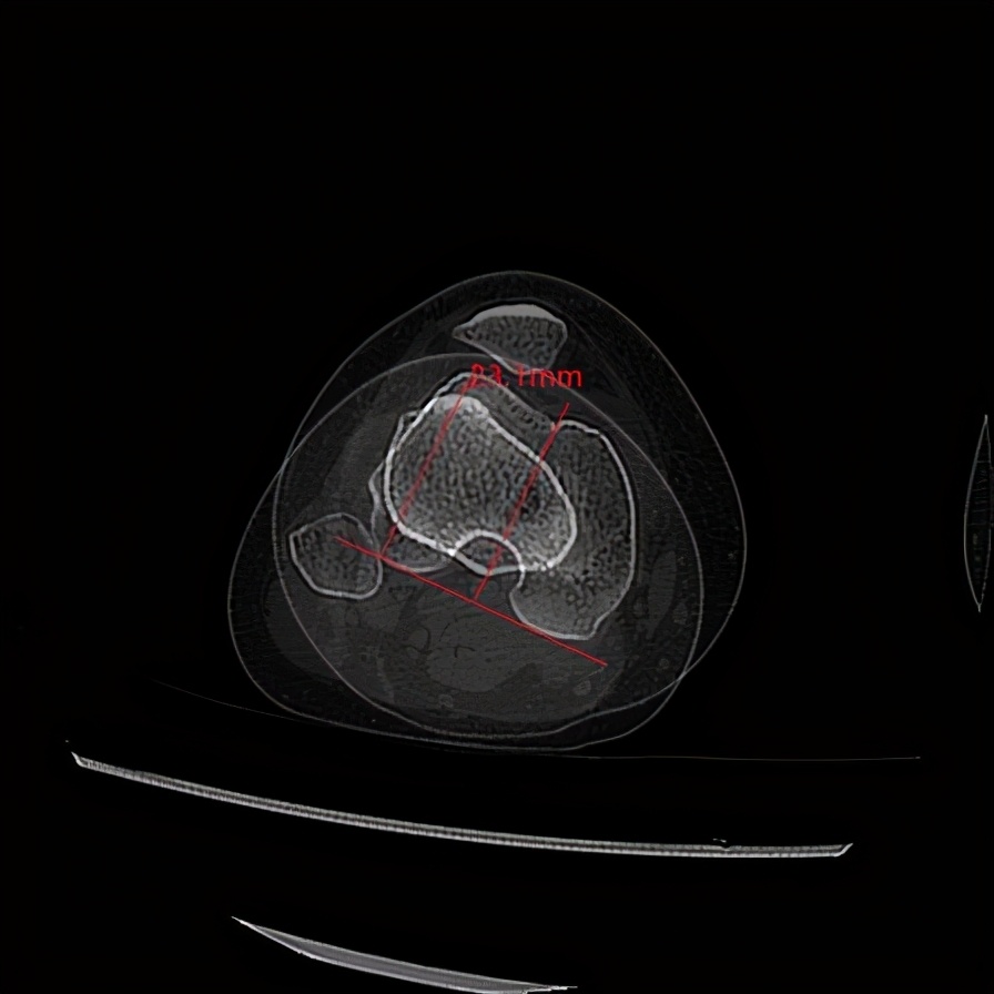 髌骨半脱位打石膏能彻底治愈吗,青少年膝盖半月板二级损伤