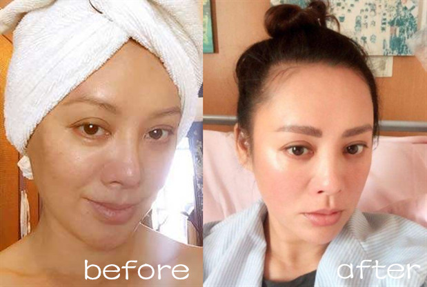 做美容的女人勇气可嘉,打了美容针的女人现在怎么样了