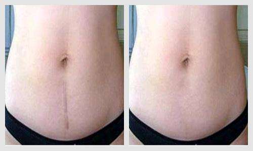 剖腹产现在是横切口还是竖切,剖腹产现在横切还是竖切