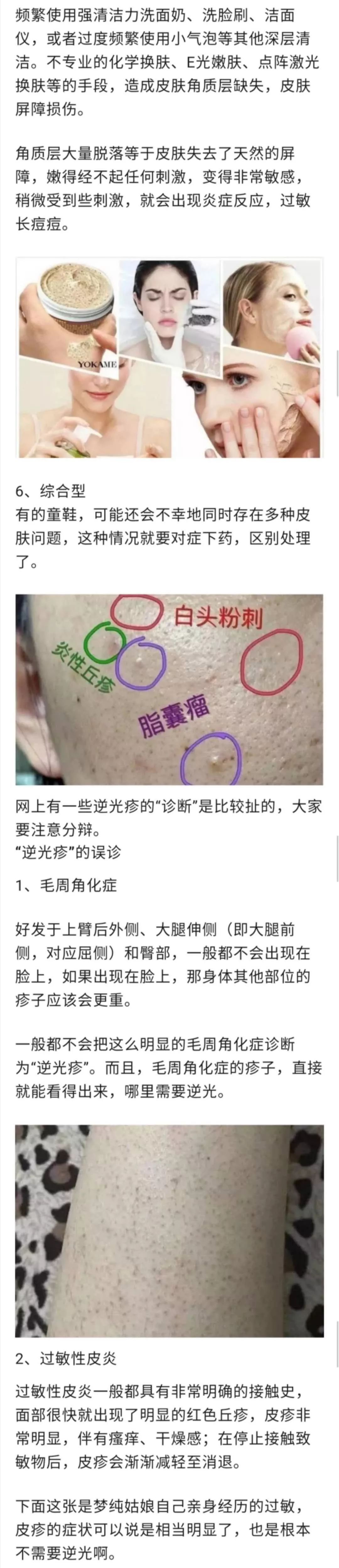 辟谣逆光疹,逆光疹是伪概念吗