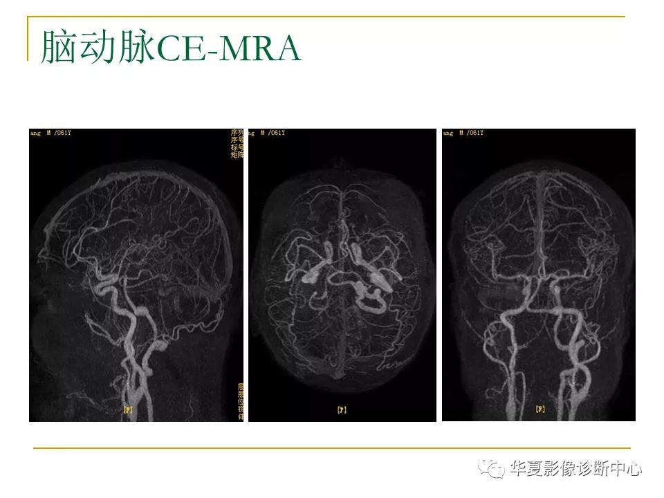 中国人脑立体定向mri应用解剖图谱,脑mri示意图