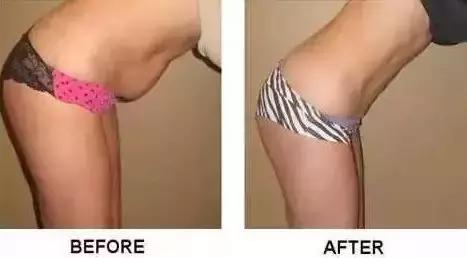 产后肚皮松像口袋一样,产后肚子松垮是腹直肌分离吗