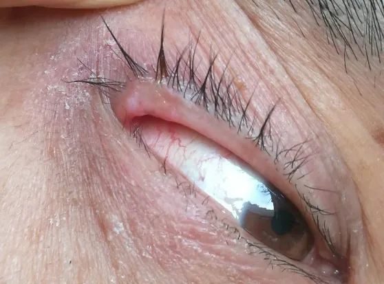 眼整形常见手术方式,眼整形美容手术