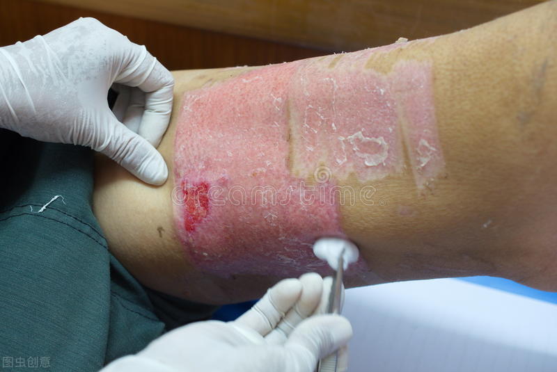 植皮手术后的注意事项,植皮手术后注意什么