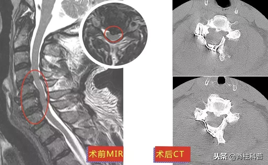 颈椎病治疗的分享,关于颈椎病通俗易懂的科普
