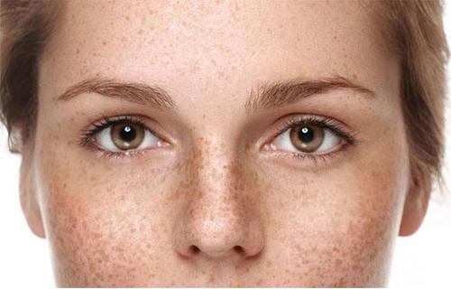 科学去除老年斑,女人长老年斑的小妙招