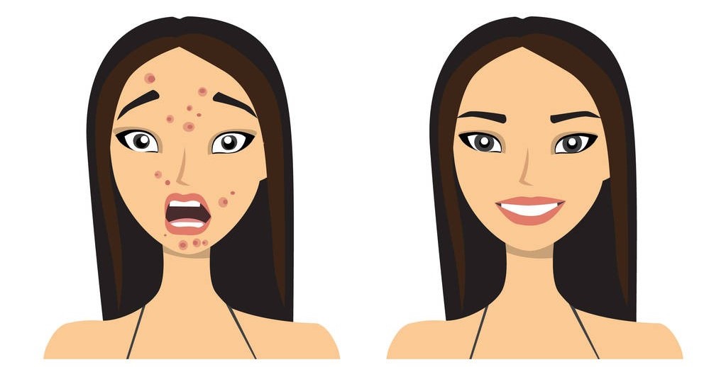 玫瑰*疮痤**患者机体免疫调节的异常，该病发病率呈现逐年上升的趋势