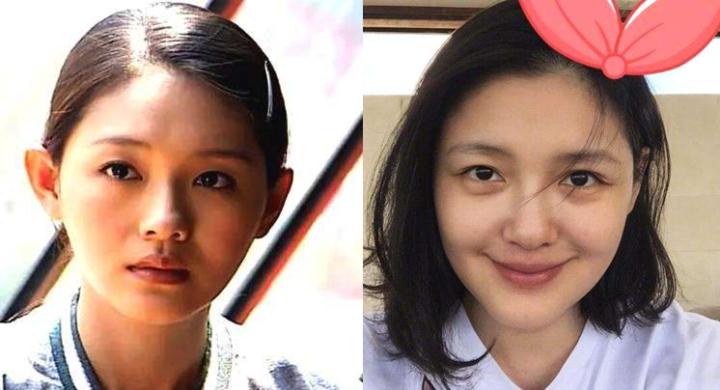 张歆艺用的什么填充脸部,张歆艺填充脸部前后对比