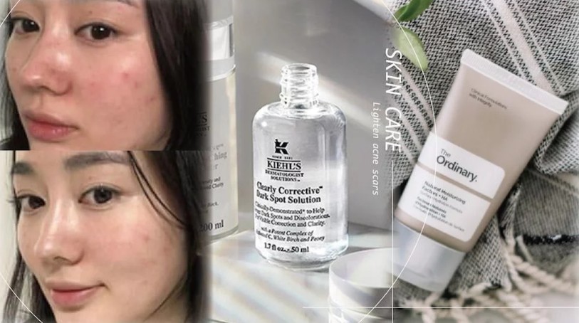 好用的祛痘印精华推荐平价,推荐一下淡化痘印的护肤品