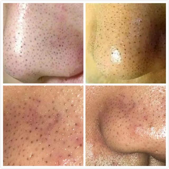 牙膏去黑头的方法靠谱吗,牙膏去黑头的正确方法