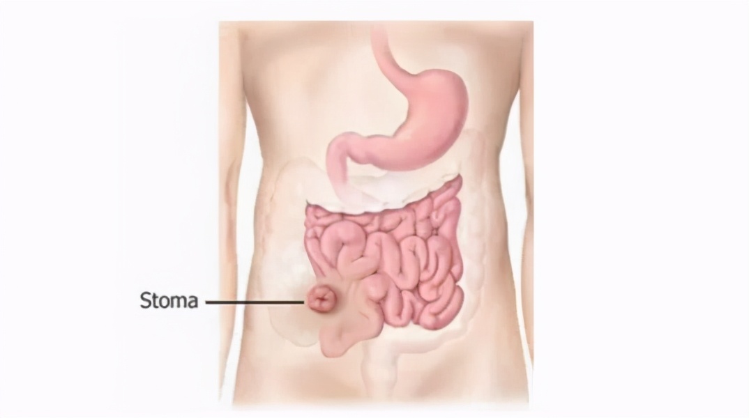 直肠癌患者，如果做了临时回肠造口，需要注意哪些事项？