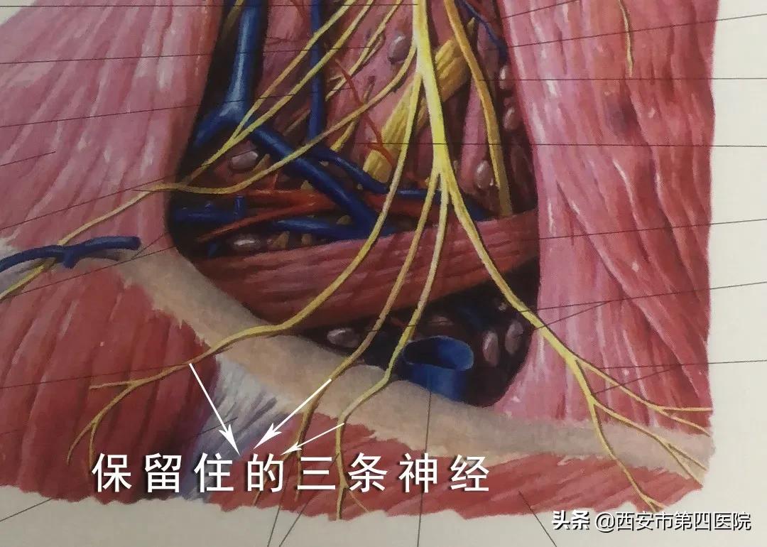 锁骨骨折保守治疗84天,公立医院锁骨骨折手术