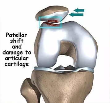 儿童习惯性髌骨脱位的手术治疗,儿童髌骨脱位怎么治疗最有效