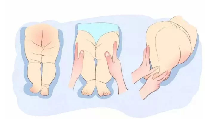 刚出生腿纹正常三个月腿纹不对称,宝宝腿纹轻微不对称怎么解决