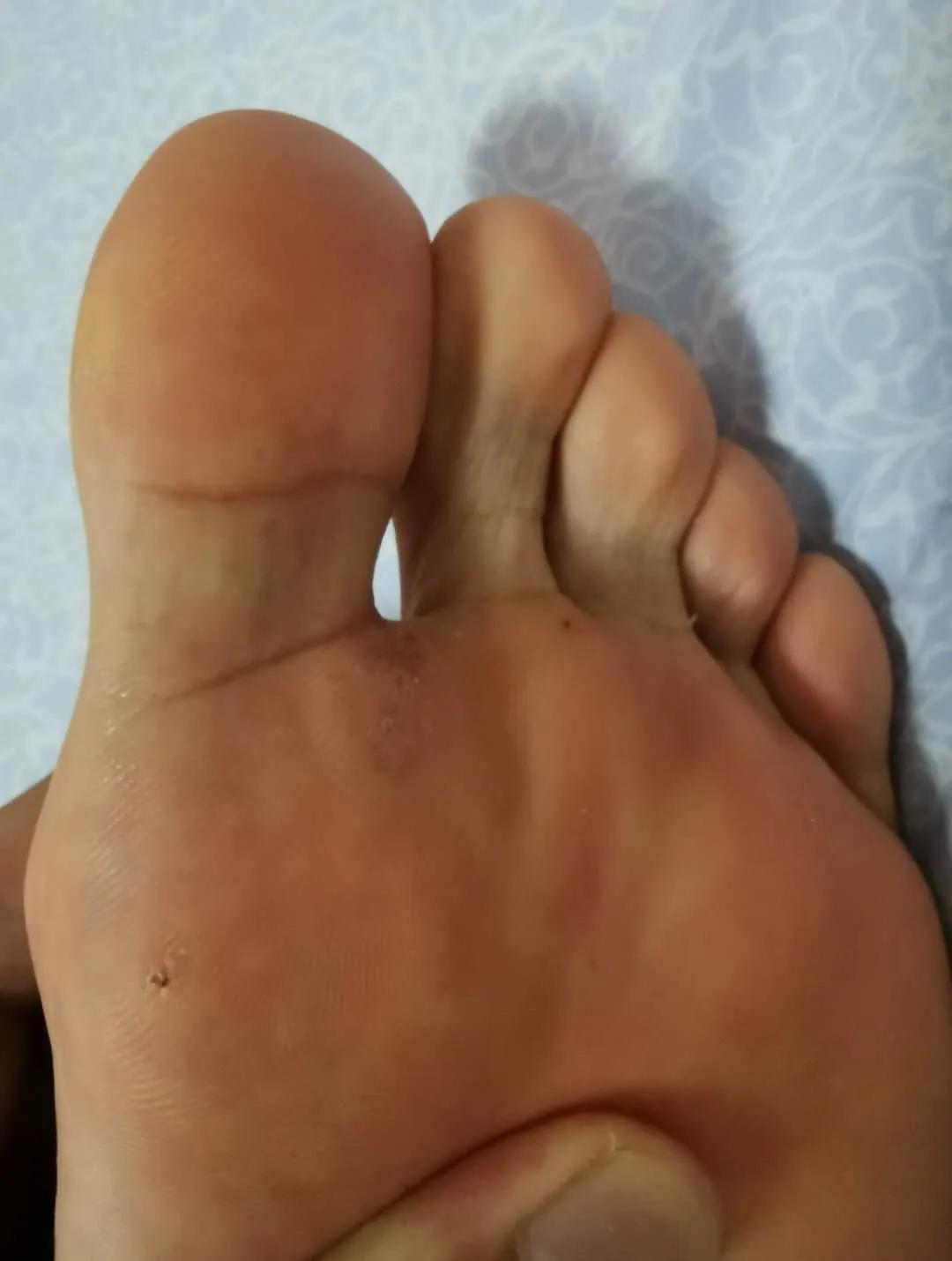 治疗跖疣火针和冷冻哪个疗效好,多发性跖疣的火针治疗