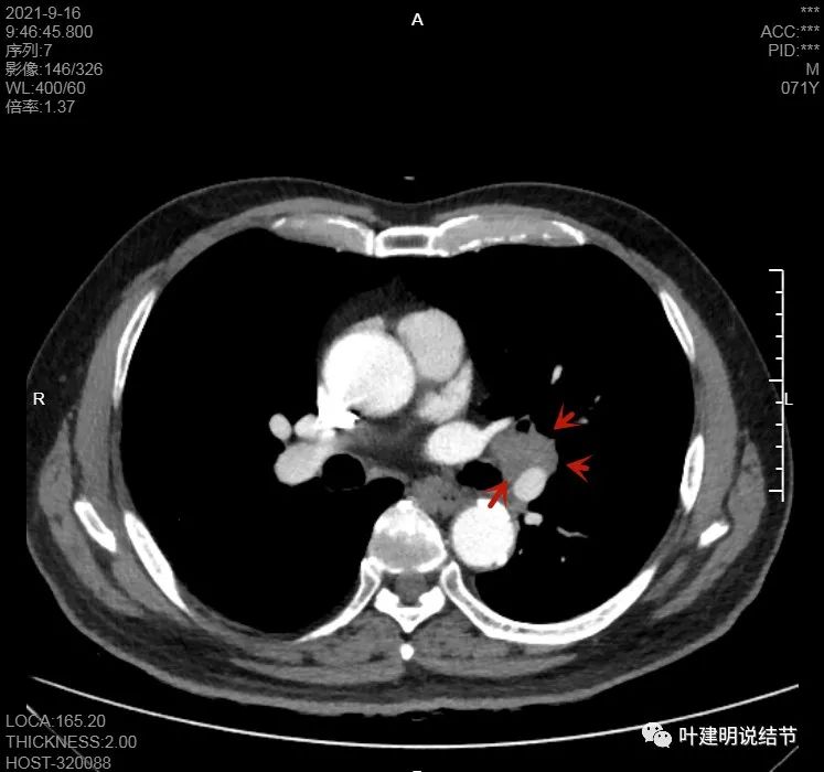 肺上有实性结节6mmx5mm是什么原因,肺上有1.7x1.8的实性结节该怎么办