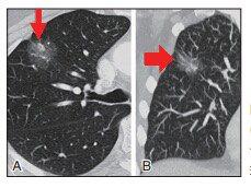 肺结节中的ggo代表什么,肺结节ggn与ggo有什么区别