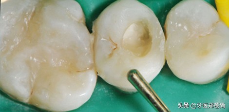 牙齿缺损除了补牙还能补吗,牙齿缺了半边能补牙带牙套吗