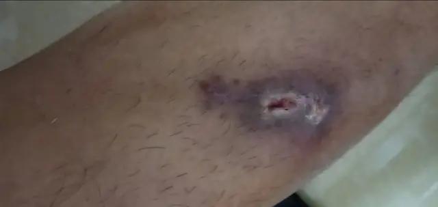 双氧水洗伤口导致周边红肿,伤口结痂感染用双氧水可以杀菌吗