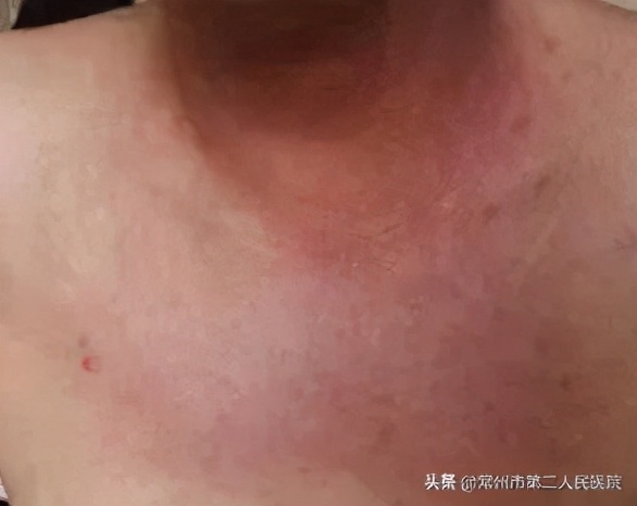 得了皮肌炎,挂号是挂皮肤科?