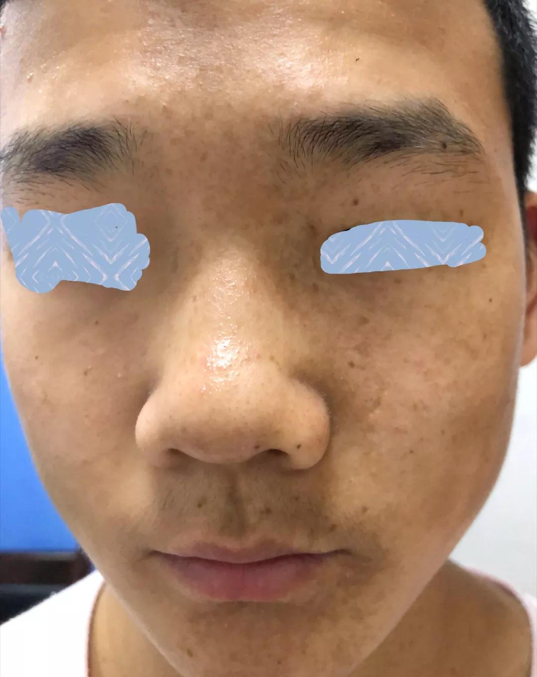 雀斑样痣是雀斑的一种吗,雀斑痣和健康痣有什么区别