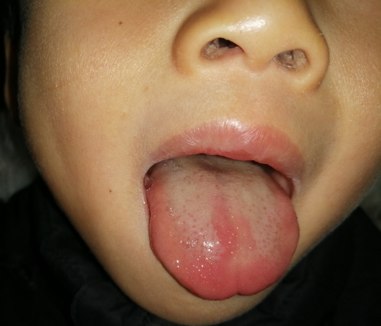 幼儿积食口臭怎么调理,幼儿积食口臭放屁臭吃什么药调理