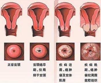 宫颈癌疫苗免费视频,关于宫颈癌疫苗的各种答疑