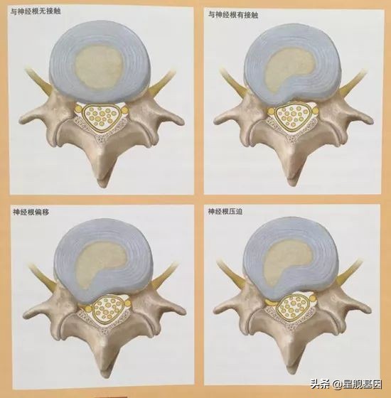 鑵版闂寸洏绐佸嚭鑳芥牴娌讳箞,鑵版闂寸洏绐佸嚭鍘嬭揩绁炵粡