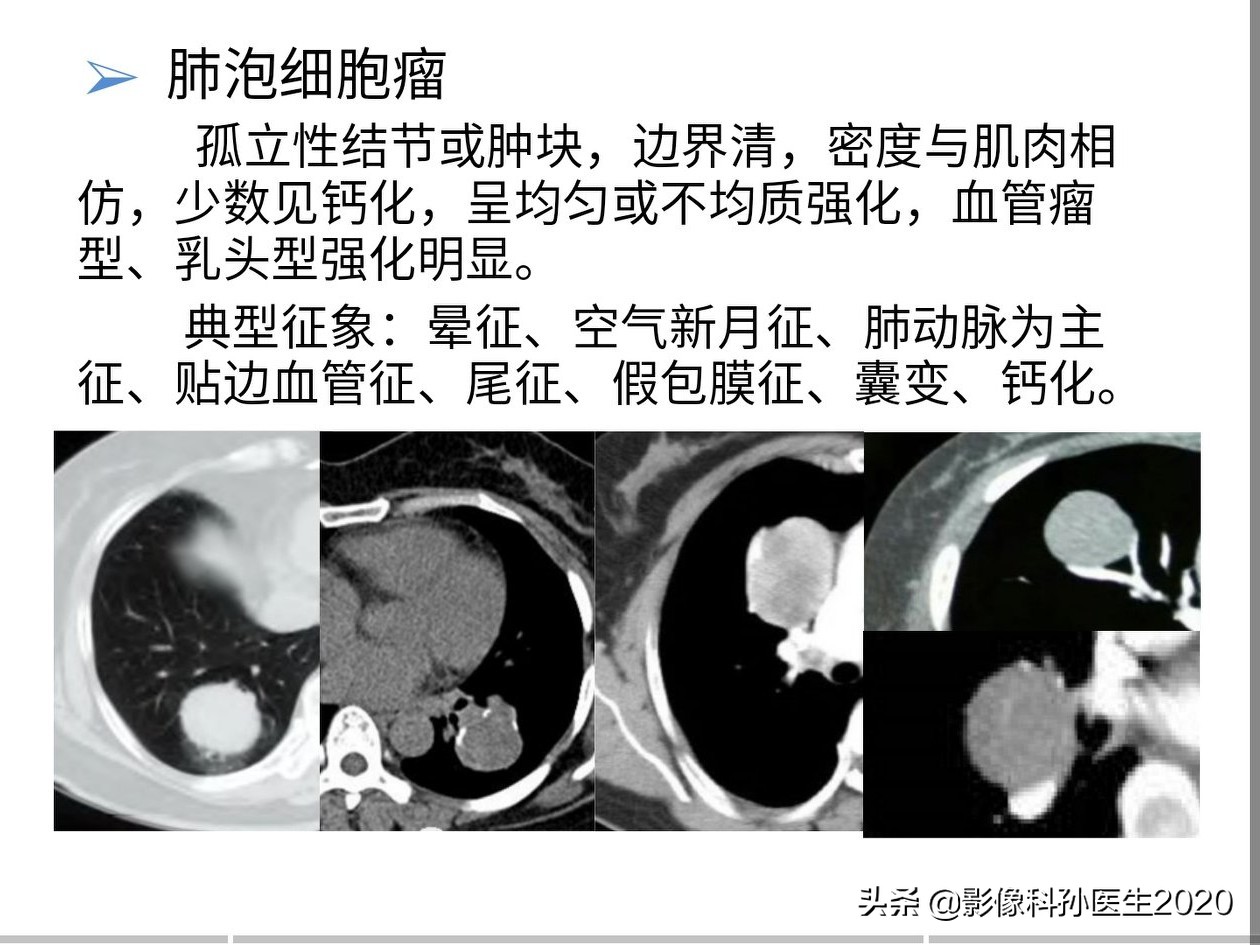 肌纤维母细胞瘤扩切能切干净吗,肌纤维母细胞瘤最好的治疗方法