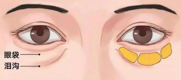 涂眼霜可以祛眼袋？不现实！祛眼袋的三种靠谱方法看这里