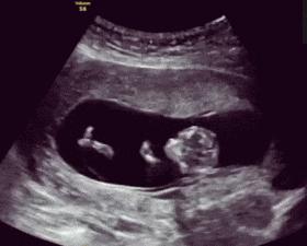 37周孕晚期突然胎动频繁怎么回事,孕晚期胎动频繁是咋回事