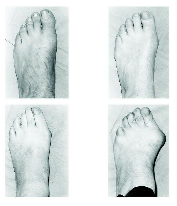 拇外翻大脚趾疼如何在家就能治,大脚拇指痛要警惕