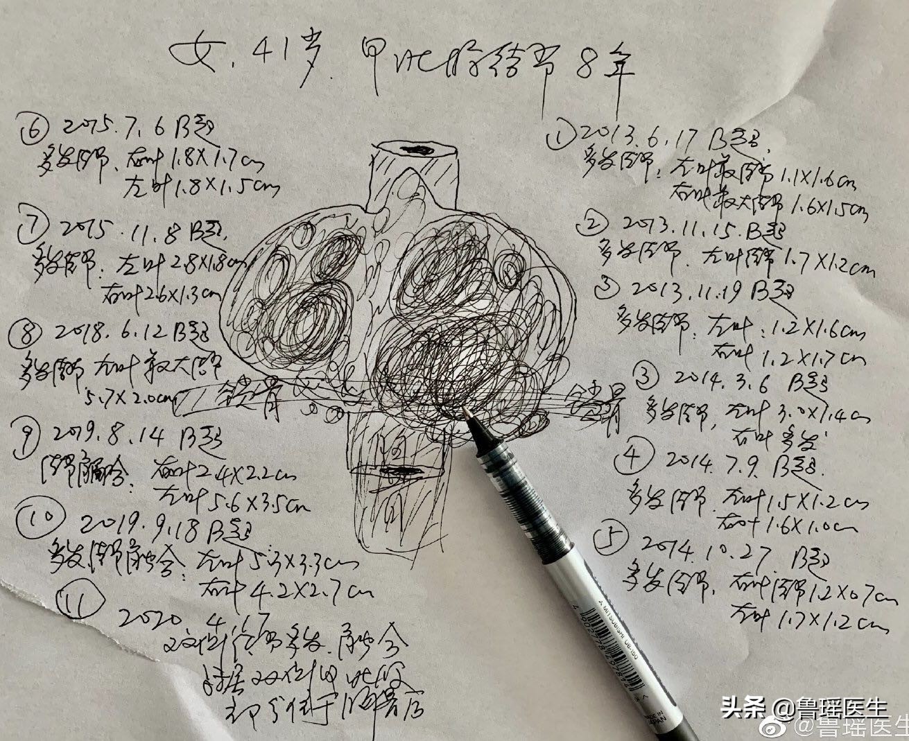 甲状腺结节靠近气管一定要手术吗,甲状腺结节多大才会压迫气管