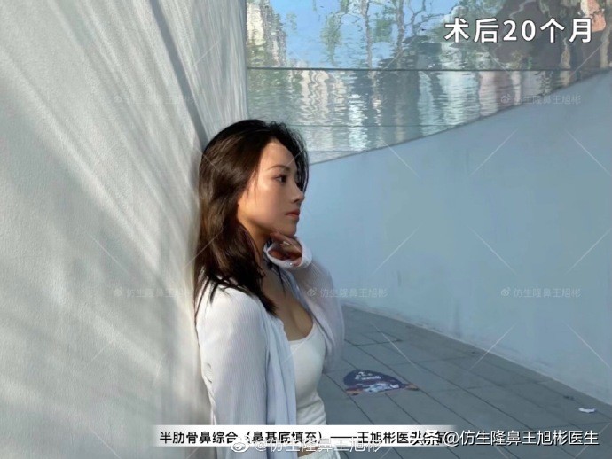 那些被鼻子“封印”颜值的鼻综合/修复案例|广州鼻整形