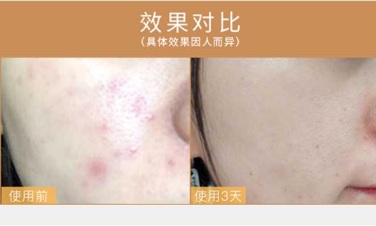三天痘痘消失,三天不洗脸痘痘没了